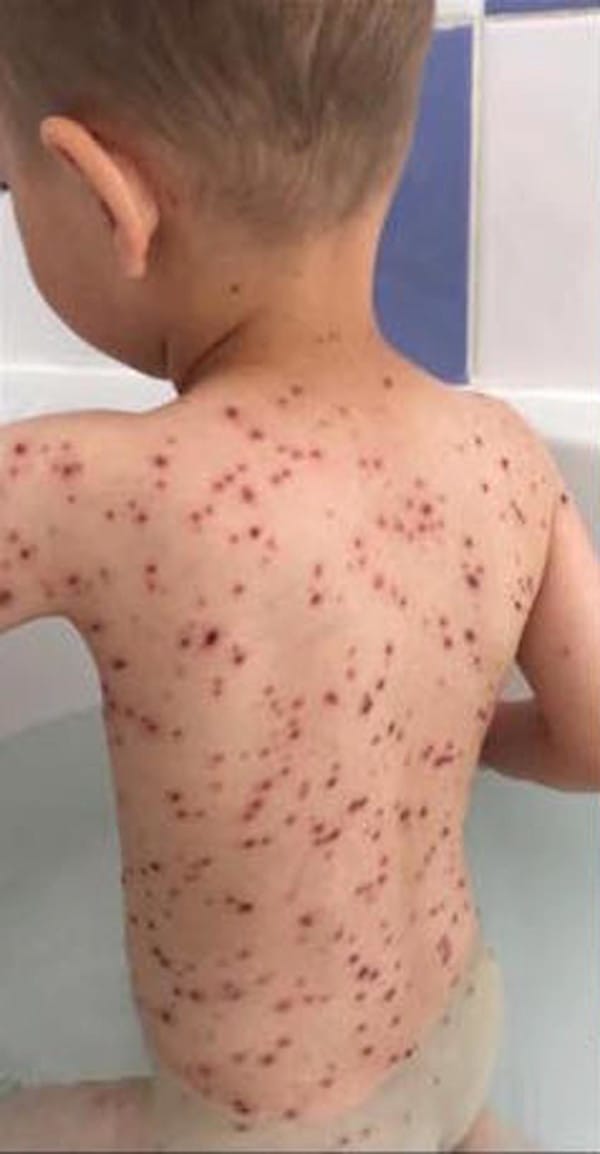 Go Ask Mum Why You Shouldn't Give Ibuprofen to a Child With Chickenpox