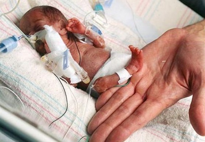 Go Ask Mum World's Smallest Surviving Baby Born at Just 8 Ounces - Go