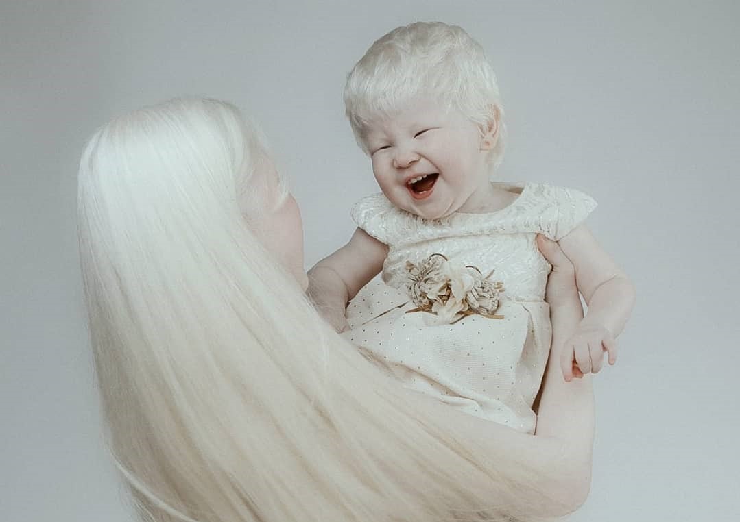 У темноволосых родителей родился светловолосый ребенок. Дети альбиносы. Альбиносы люди. Альбинизм у детей.